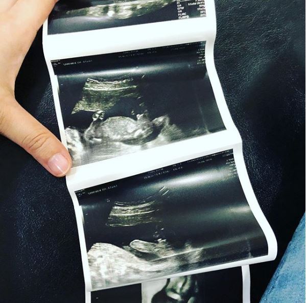 Foto imbasan ultrasound yang dikongsi Mia.